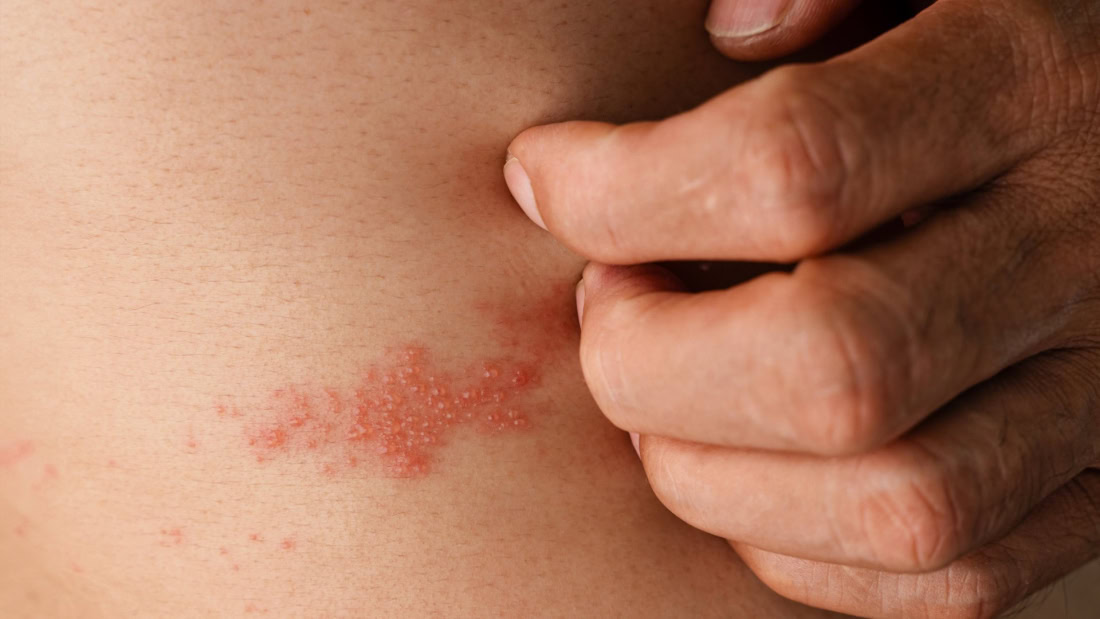 Skin with shingles rash on abdomen, rash and sore skin.