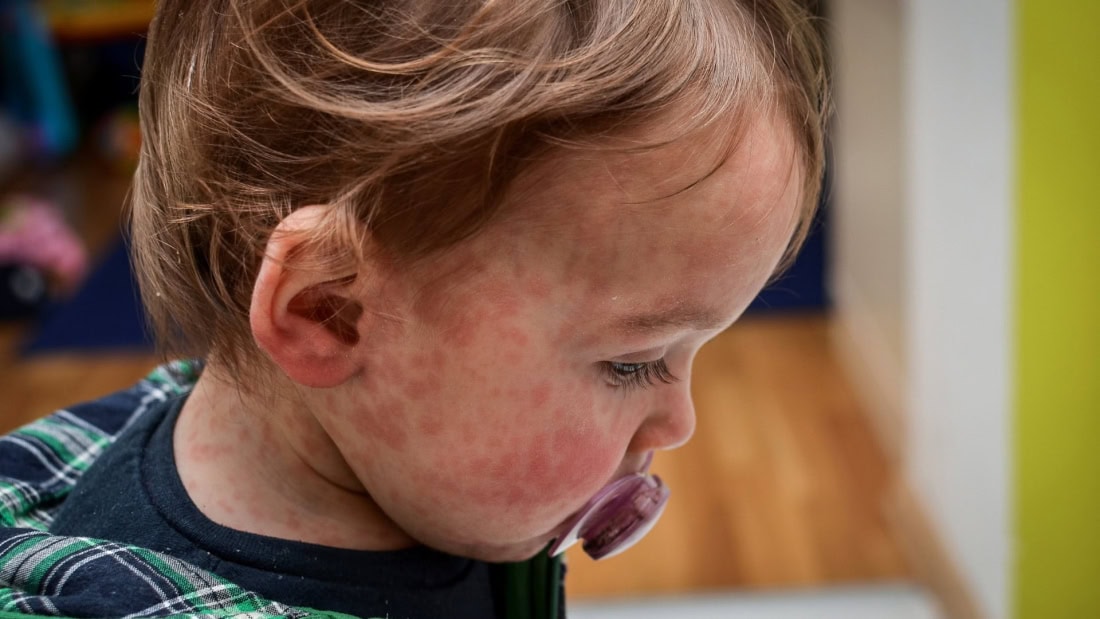 Skin rash and fever in a child with measles, medical condition.